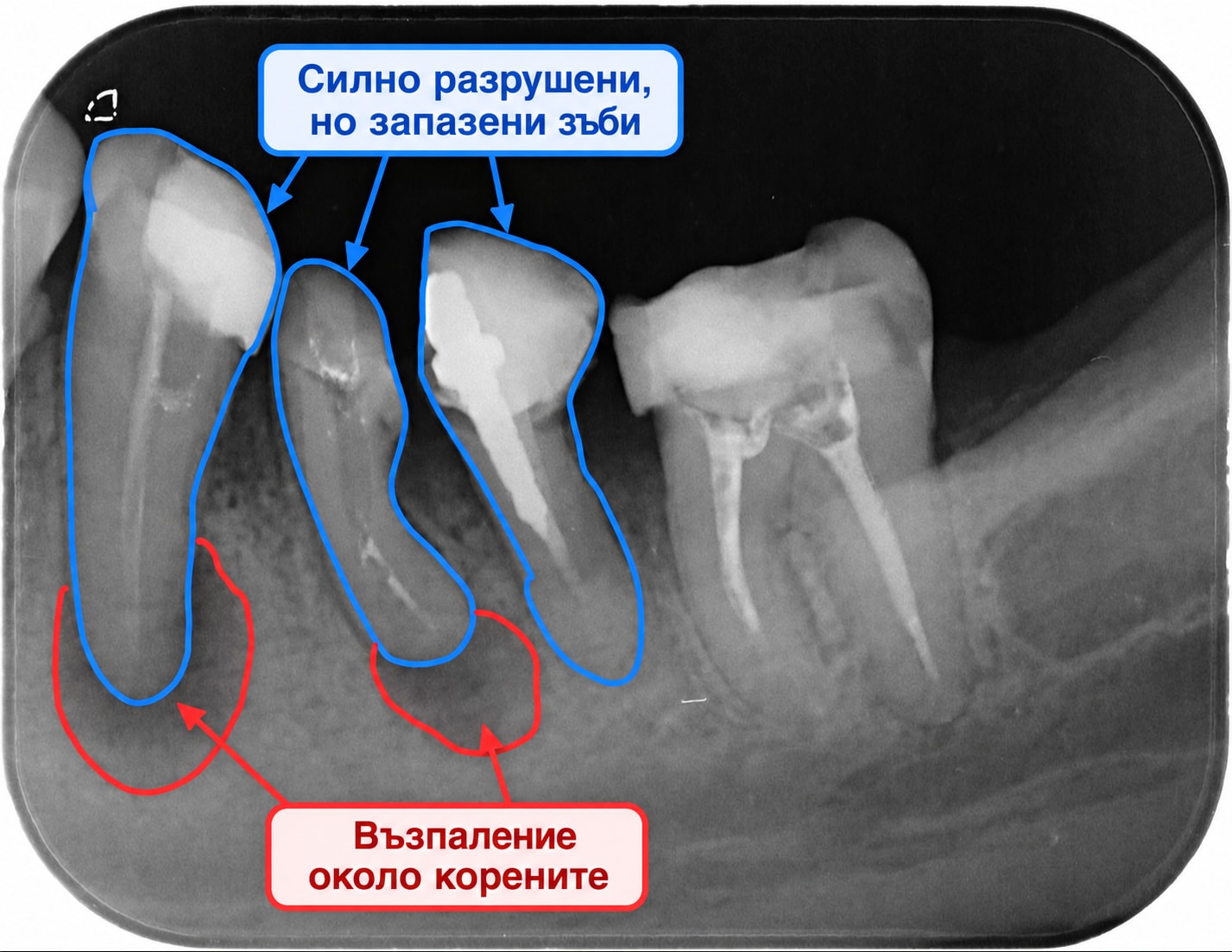 Силно разрушени зъби и възпаление около корените — начална рентгенография