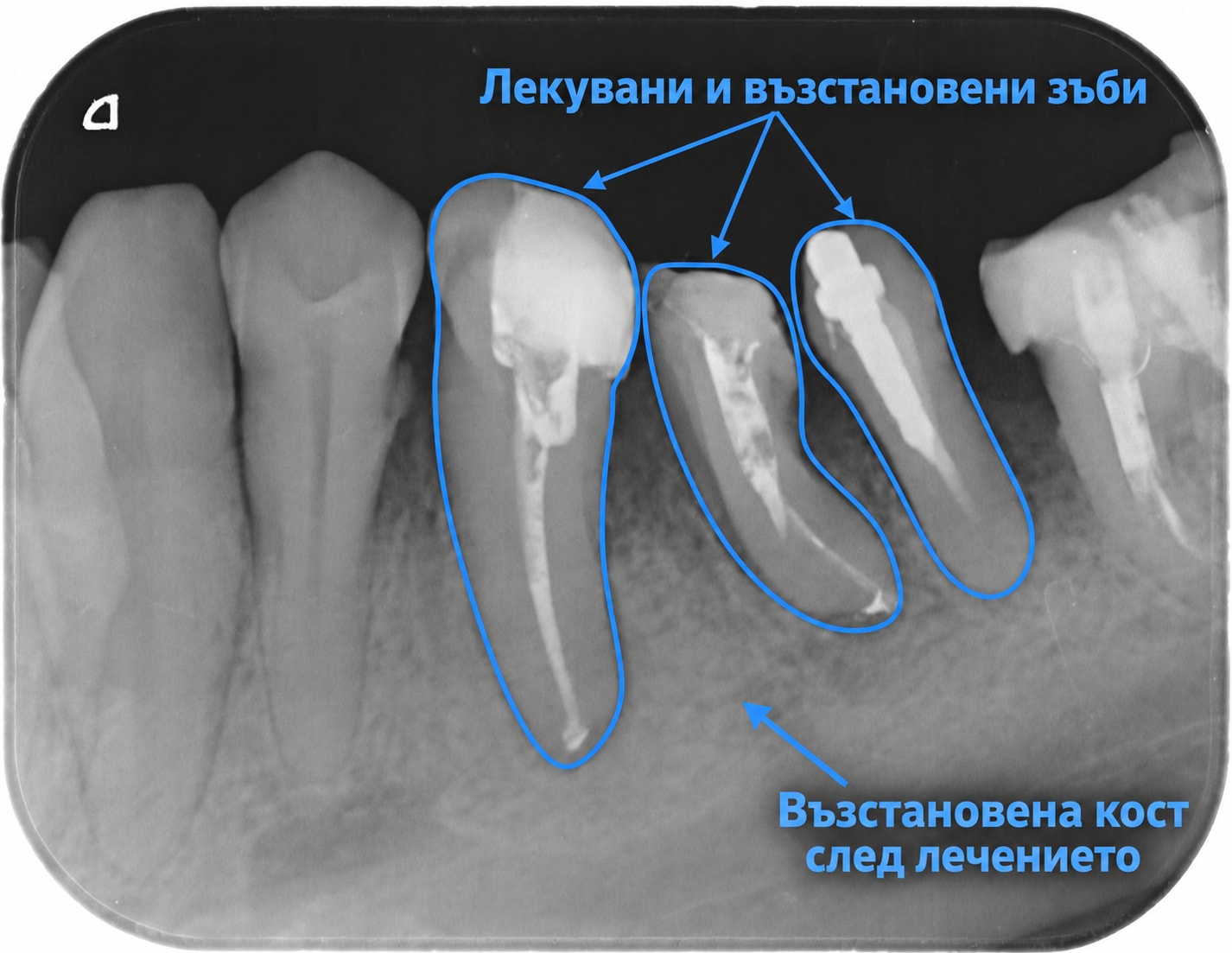 Лекувани и възстановени зъби с възстановена кост — контролна рентгенография