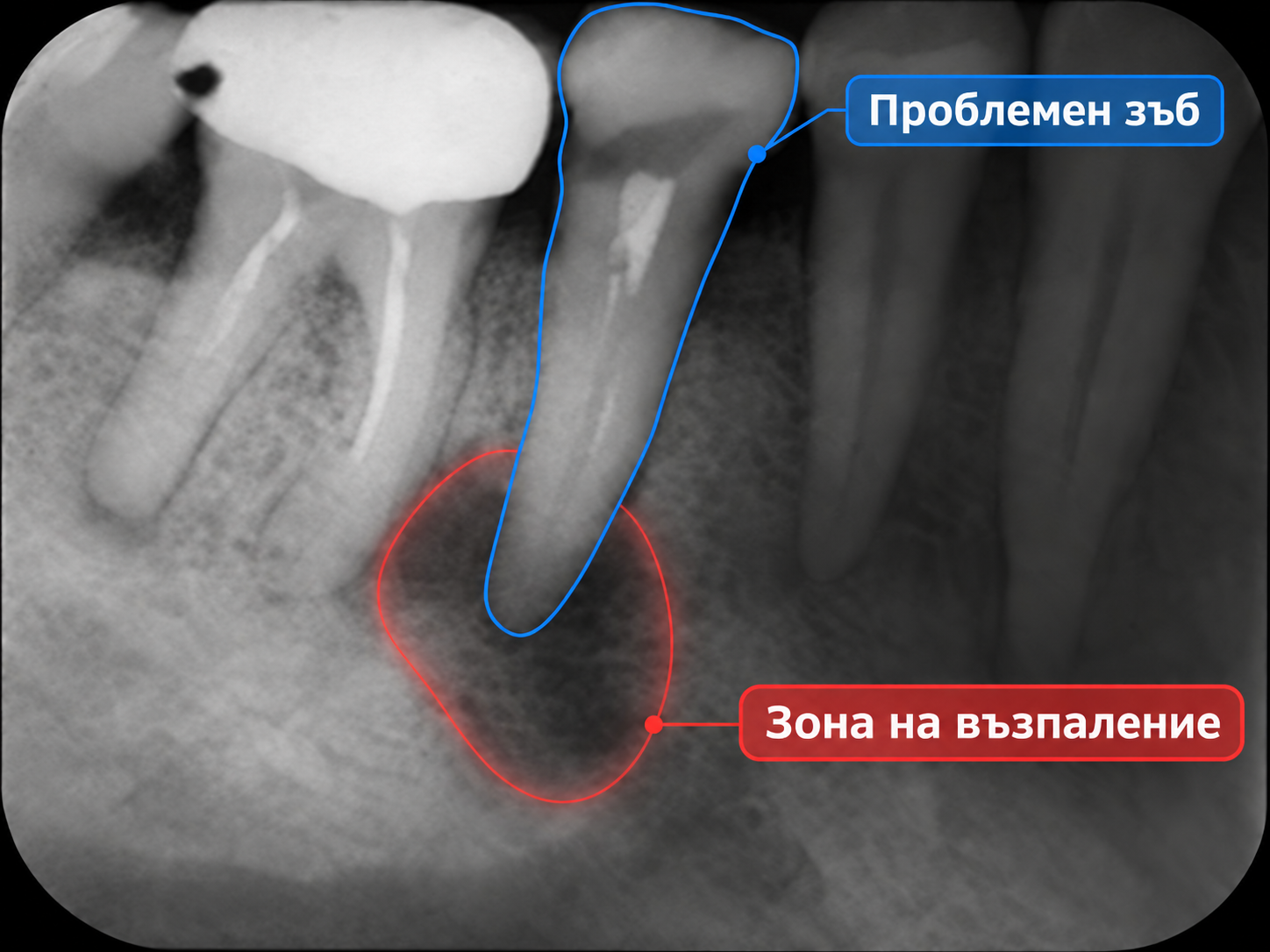 Първа снимка — проблемен зъб и зона на възпаление около корена
